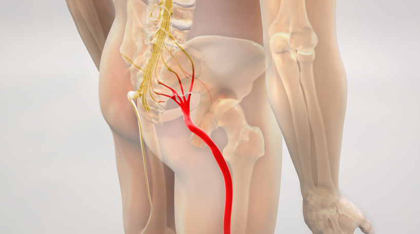 Sciatica pain relief