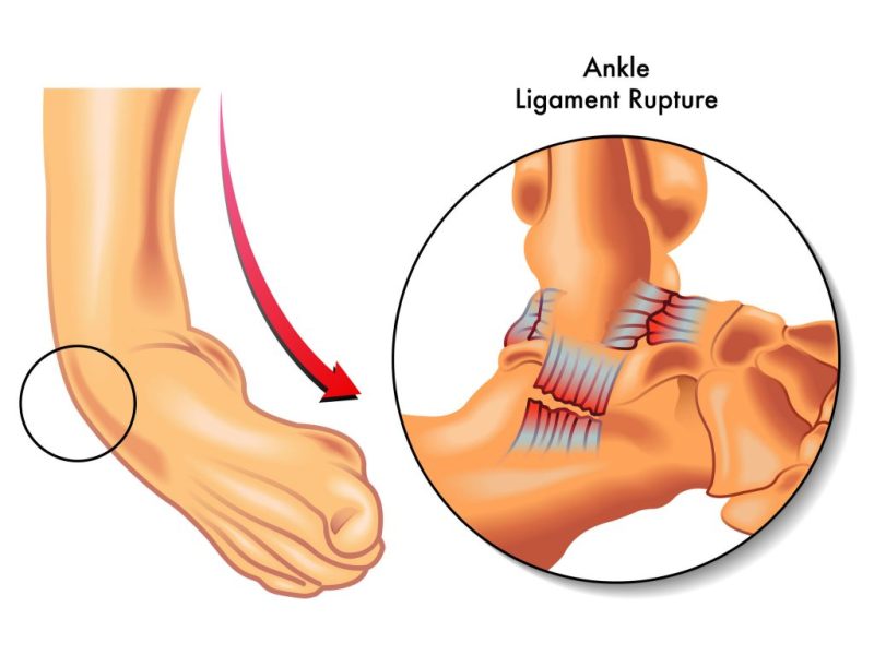 Ankle Sprain