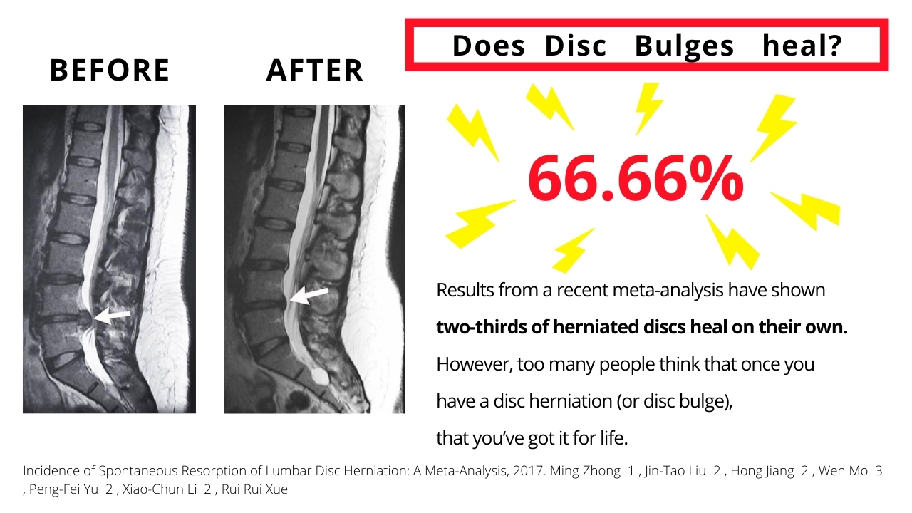 Does disc bulges heal and how long does it takes? Dublin Sports