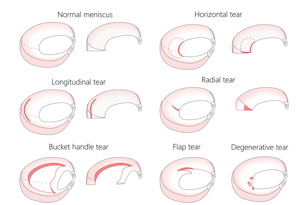 meniscal tear