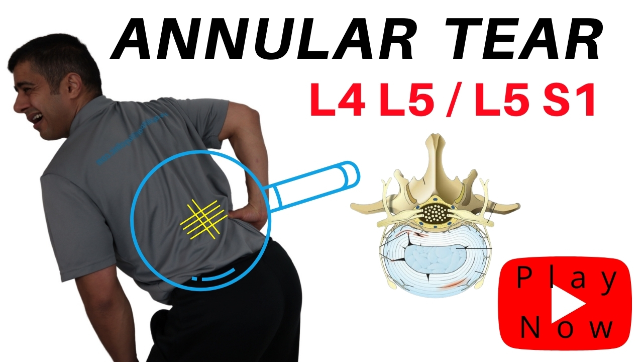 Annular Tear Treatment