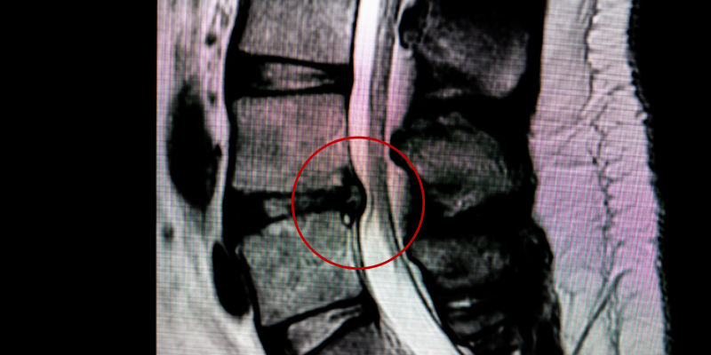 Annular Tear L4L5 L5S1 Disc Bulges treatment