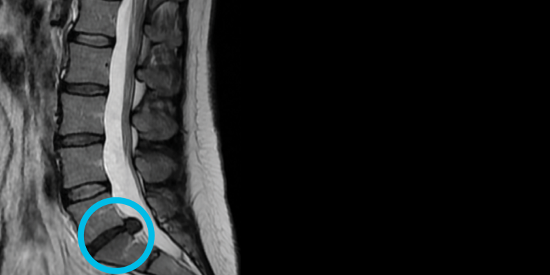 Herniated Discs Treatment and Management