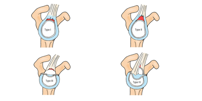 Shoulder Injury (SLAP Tear Management)